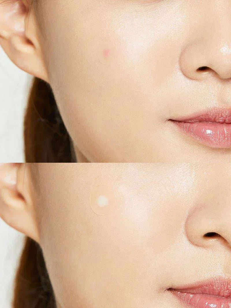 COSRX_Acne_Pimple_Master_Patch_24_Patches_-_Miessential-1601225 - GlowTheory Co